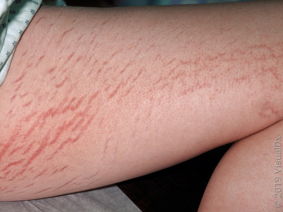 Close-up of new stretch marks on the thigh. 