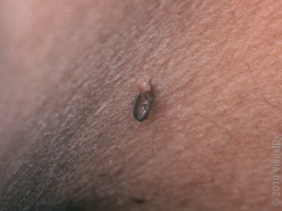 A close-up look at a skin tag (acrochordon). 