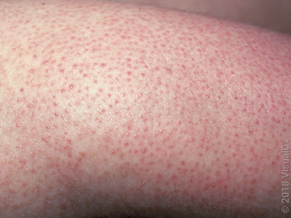 Keratosis on the arm in fairer skin. 
