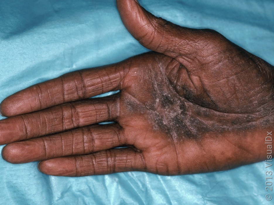 Close-up of ringworm on the hand (tinea manuum).