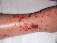 What Causes Red Hives On Legs Infoupdate