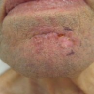 A close-up image shows a basal cell carcinoma on an ear lobe in a person with  dark skin.