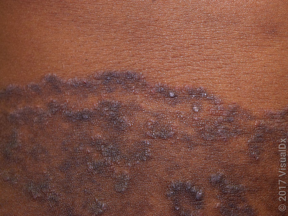 Close-up of a rash in jock itch. 