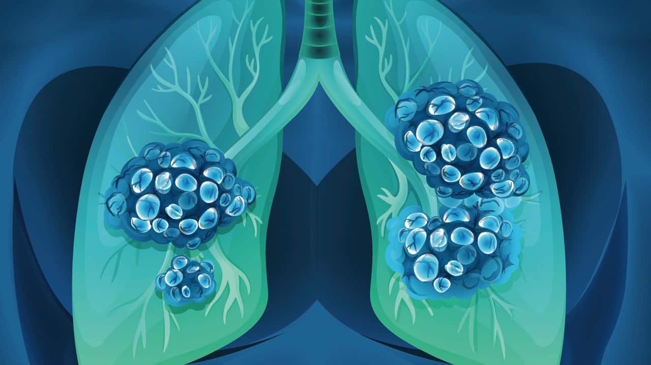 getting-an-advanced-non-small-cell-lung-cancer-diagnosis-what-you-need