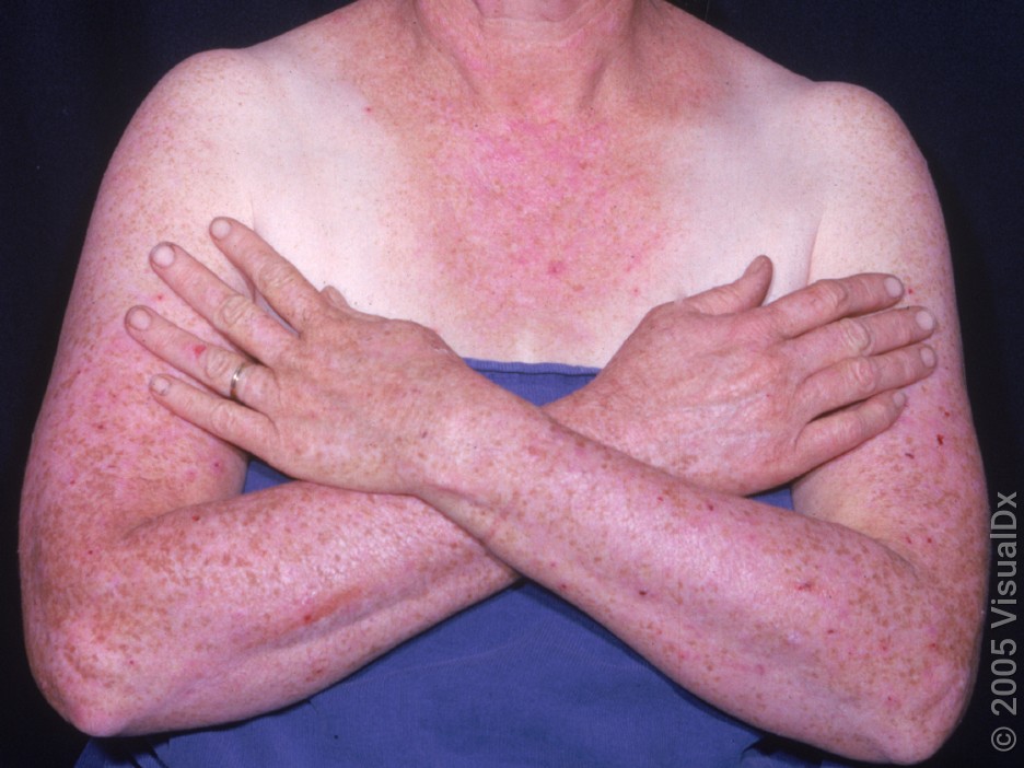glp 1 sun sensitivity Sun Allergy: Causes, Treatment, Symptoms (With Photos)