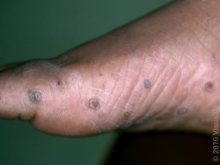 6 Pictures of Warts and How to Treat Different Types - GoodRx