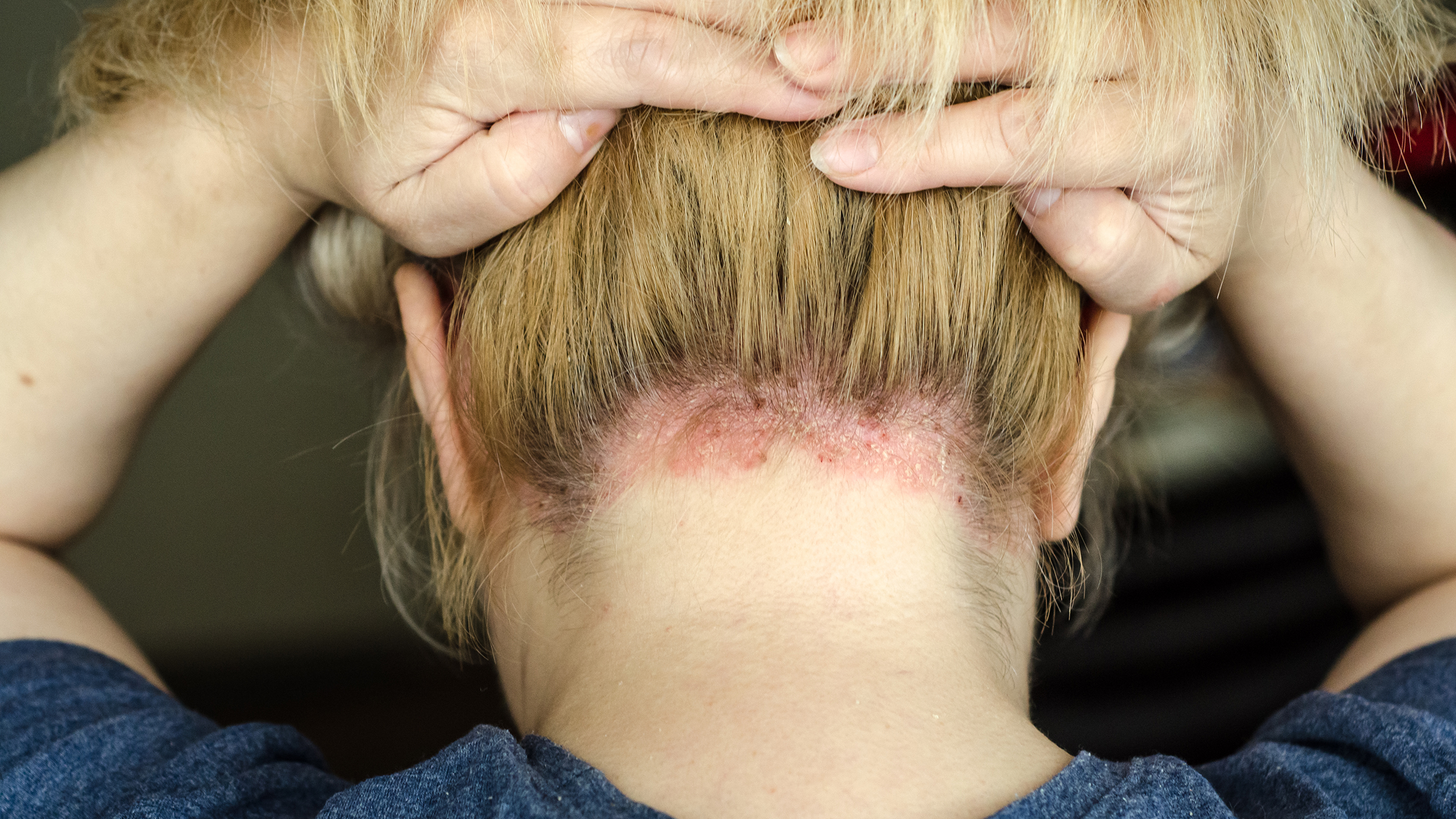 semaglutide and psoriasis Ozempic for Psoriasis?: How It Works and Who Can Use It