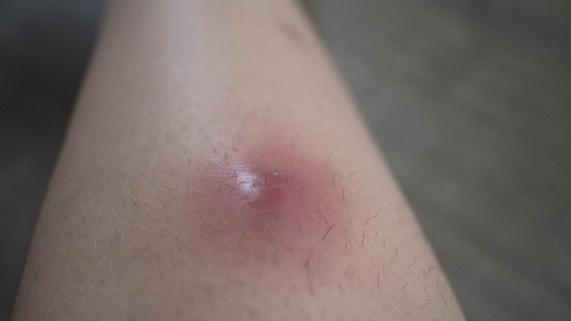 ingrown-hair-staph-infection