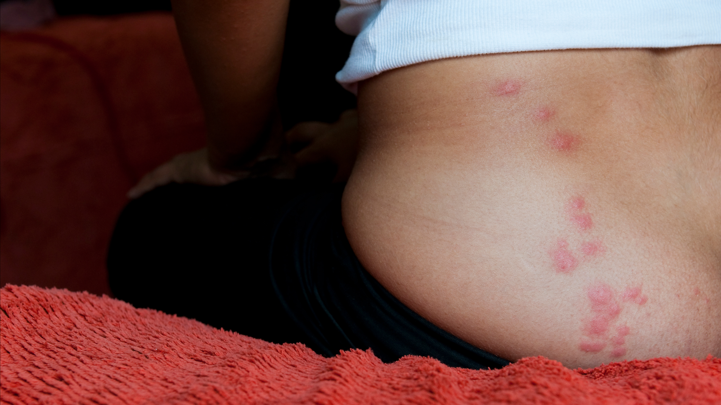 Dermatology: closeup woman with bed bug bites 157635453