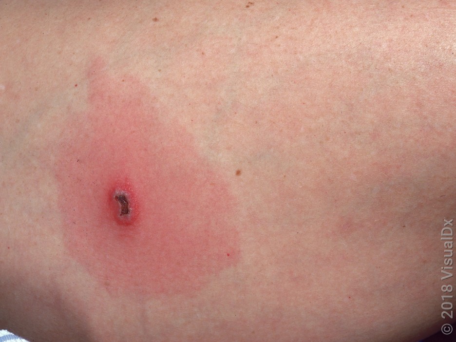 Close-up of a spider bite with a dark center bite surrounded by redness. 