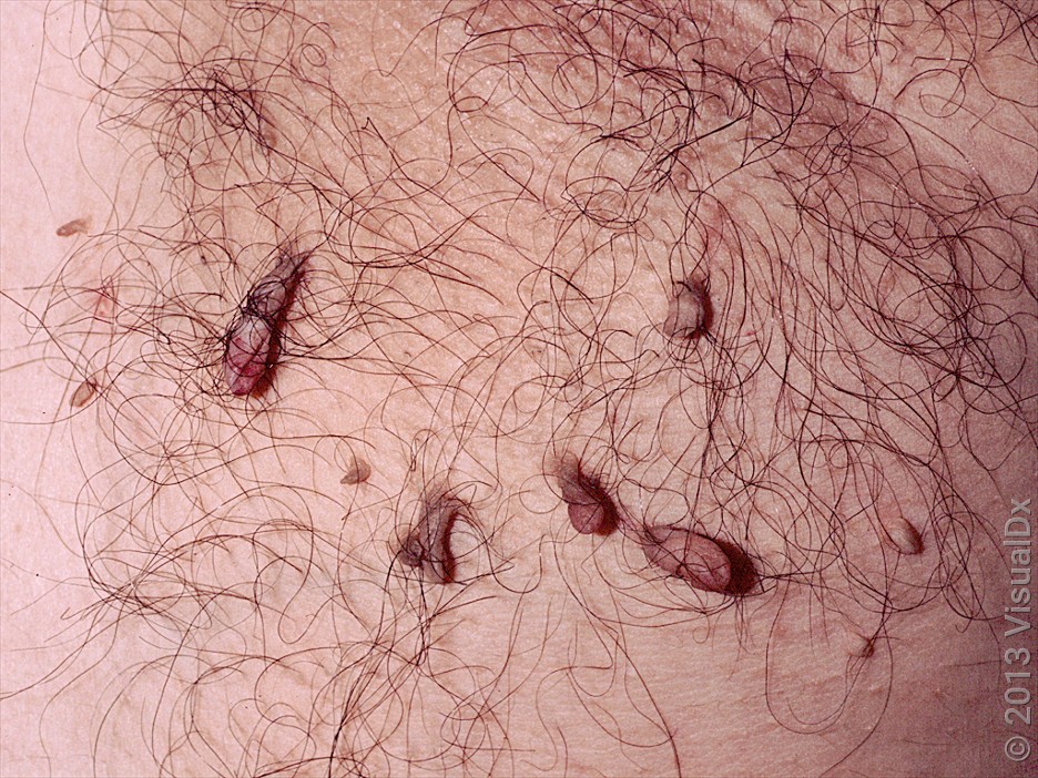 Close-up of skin tags in the armpit.