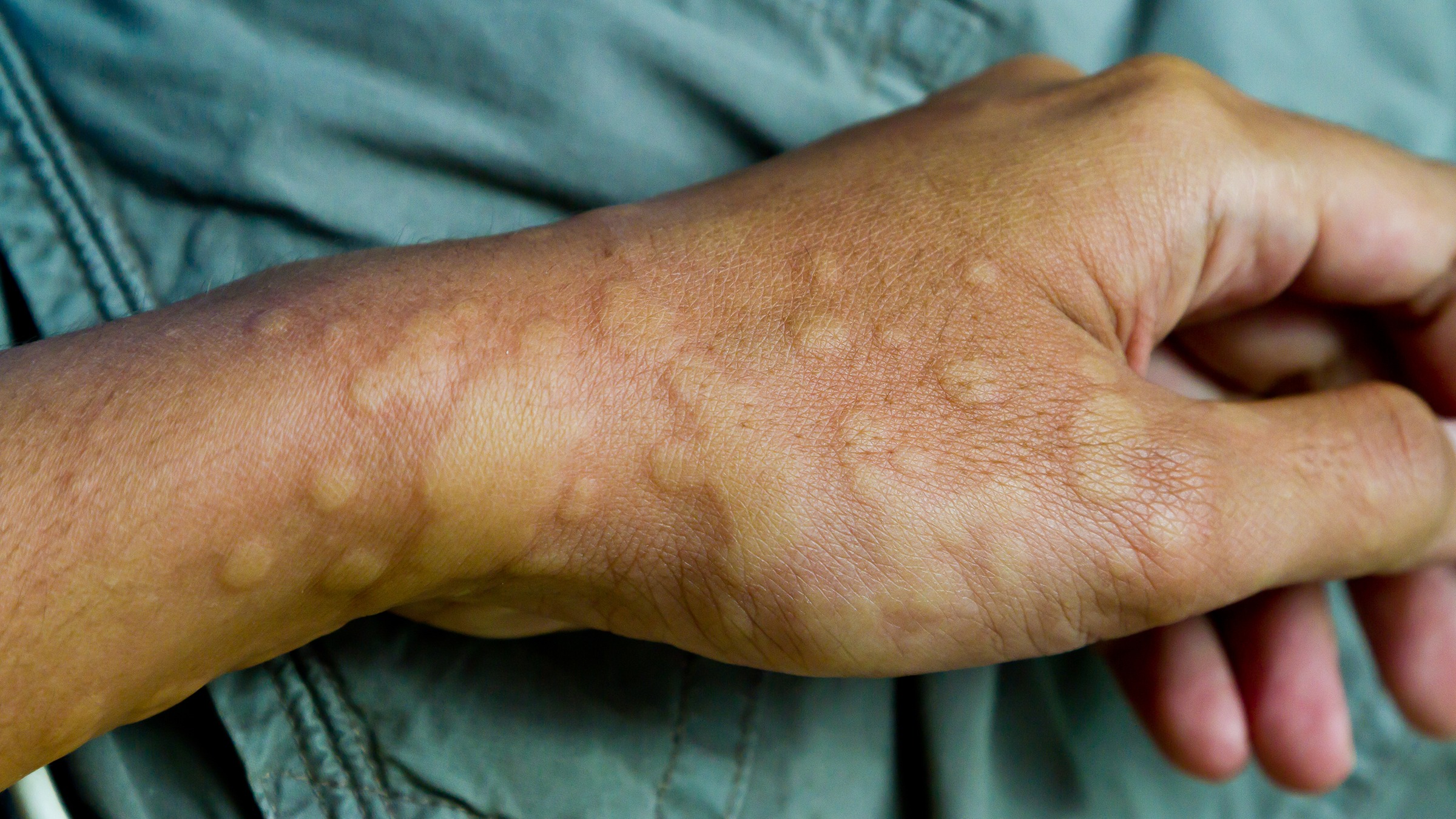 Ringworm fungal infections are common in the US and are becoming  increasingly resistant to treatment – 6 questions answered