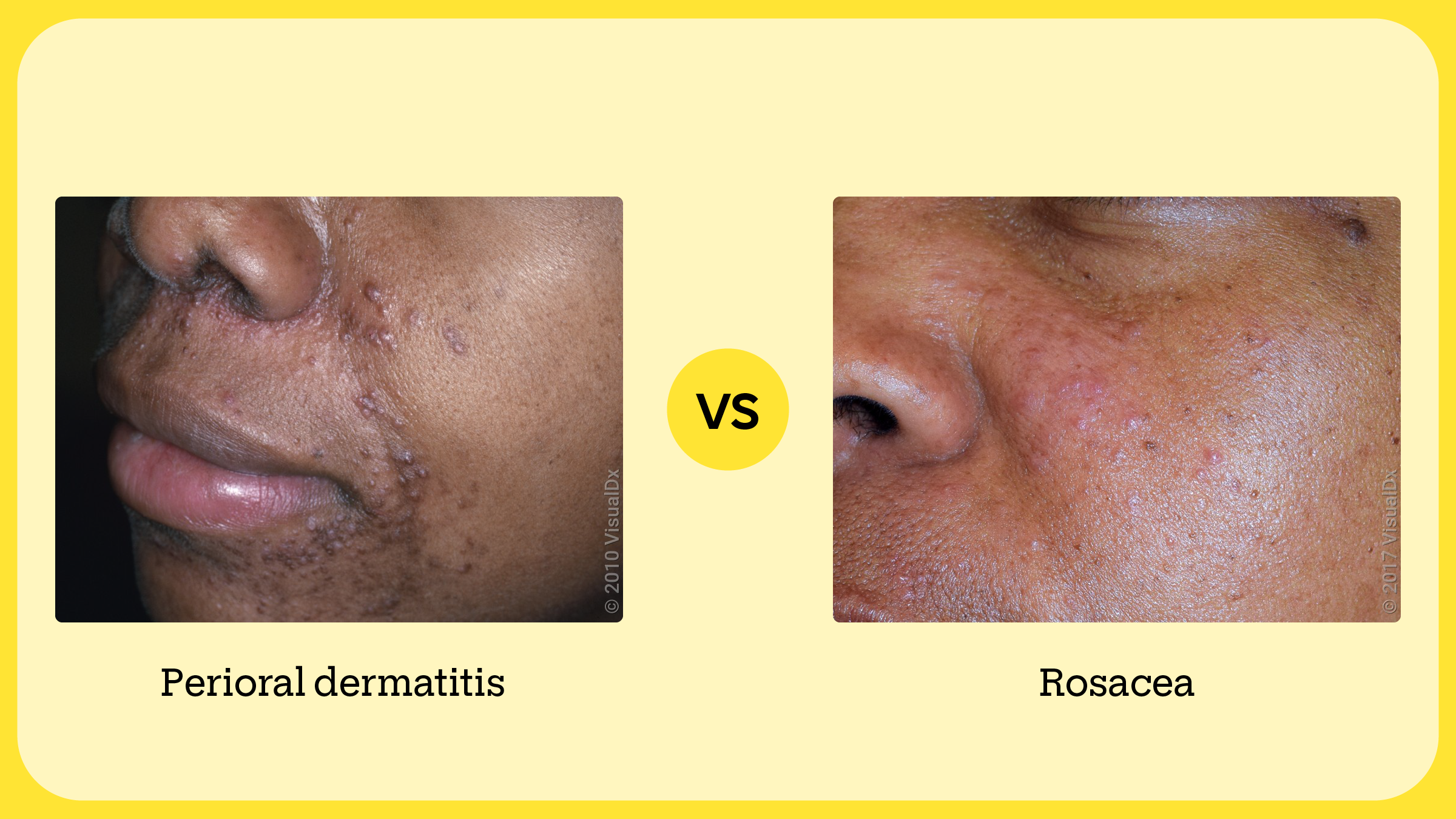 Comparative visual aid showing perioral dermatitis vs rosacea on darker skin