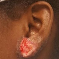 A close-up image shows a basal cell carcinoma on the chin of a light-skinned man.
