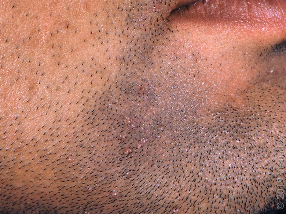Flat warts are common in the beard area, and are spread by shaving.