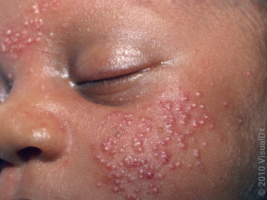 Many small, red and white bumps on the cheek and forehead in baby acne.