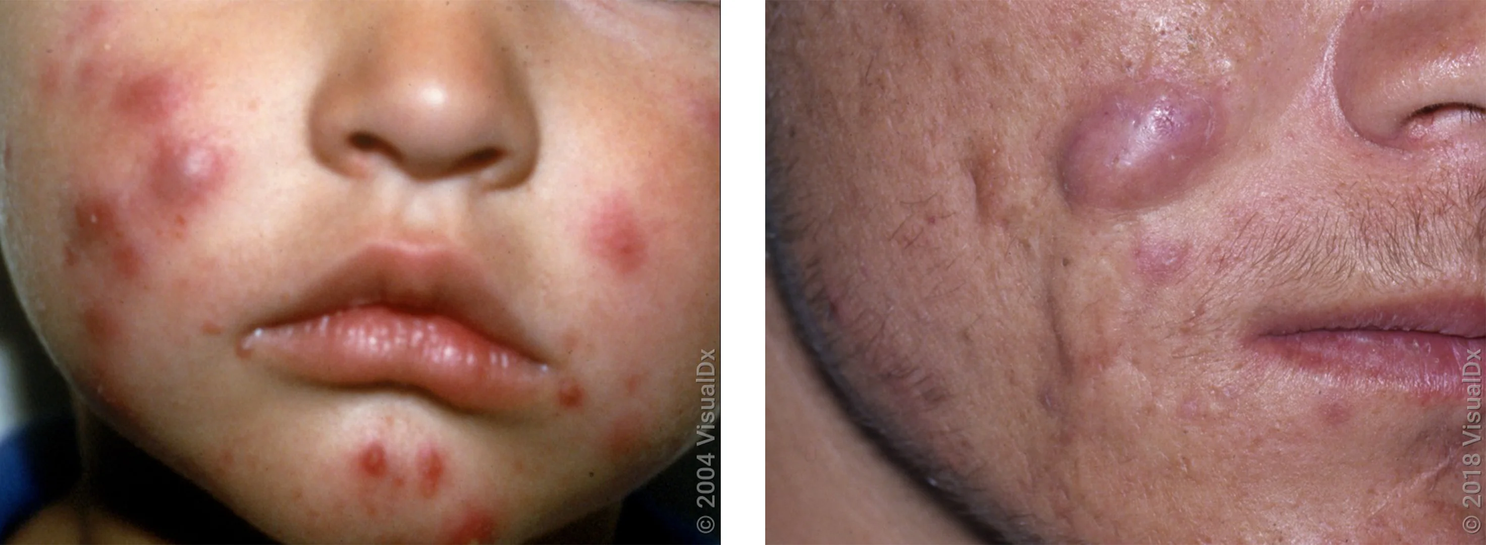 Left: Several large red-violet skin bumps on the cheek mixed with smaller red bumps (pimples) on the face. Right: A large, smooth pink skin bump (acne cyst) on the cheek near small flat scars. 