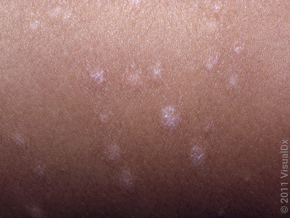 Close-up of guttate psoriasis on darker skin.