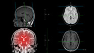 What Is Chronic Traumatic Encephalopathy GoodRx