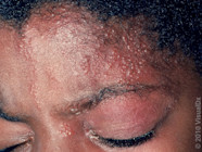 Chickenpox In Darker Skin Tones Images And Treatment GoodRx