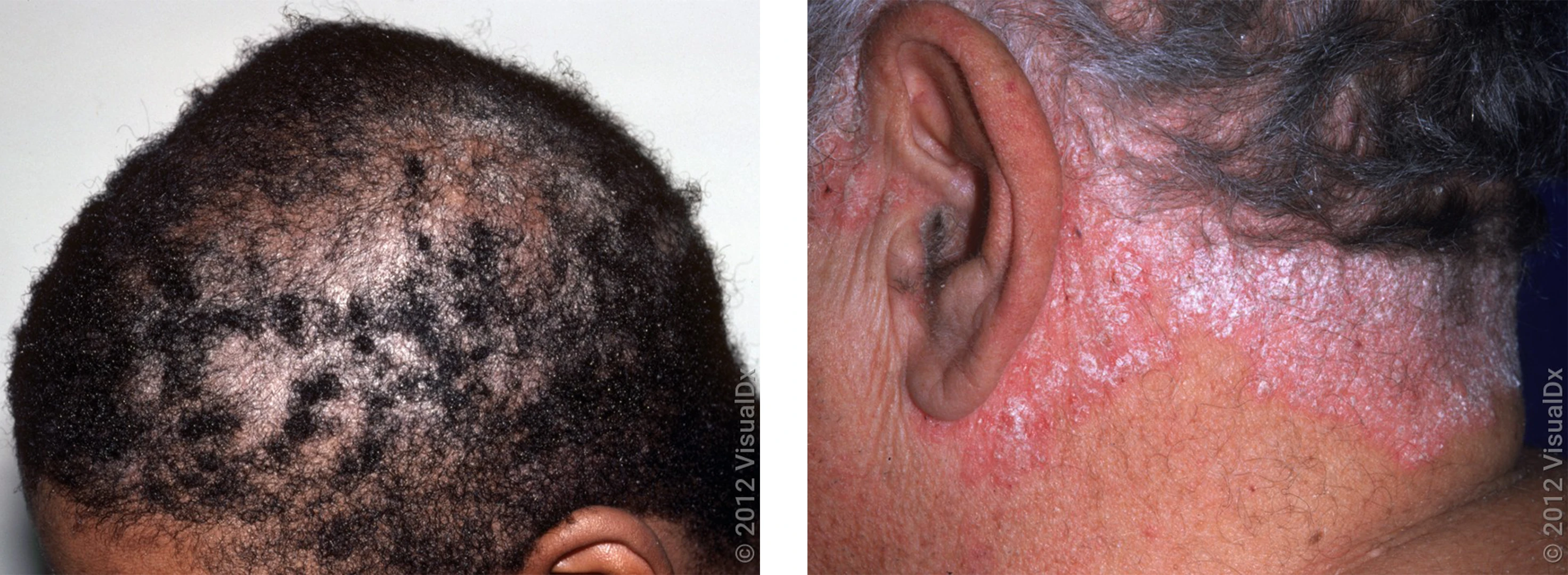 Left: A scalp with thick, white patches and hair loss (scalp psoriasis). Right: Red skin patches with thick, white scale on the neck and hairline (scalp psoriasis).