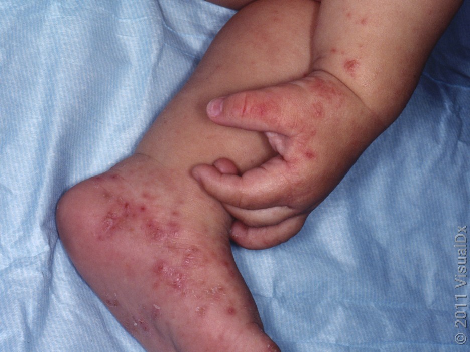 Many pink and red bumps and patches on the hand, foot, and arm of an infant with scabies. 