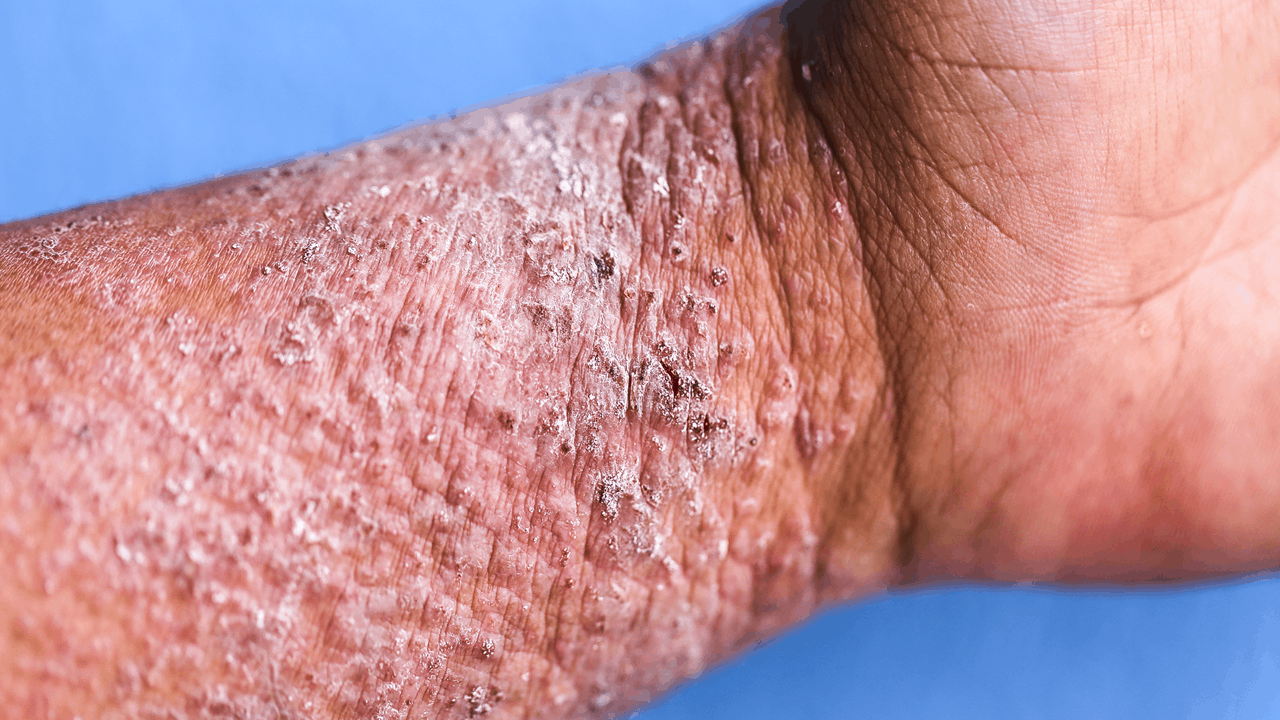 Venous Stasis Dermatitis: Images, Causes, and Treatment - GoodRx