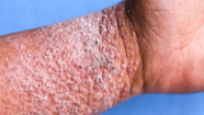 Dermatologist Approved Solutions For Severe Eczema GoodRx