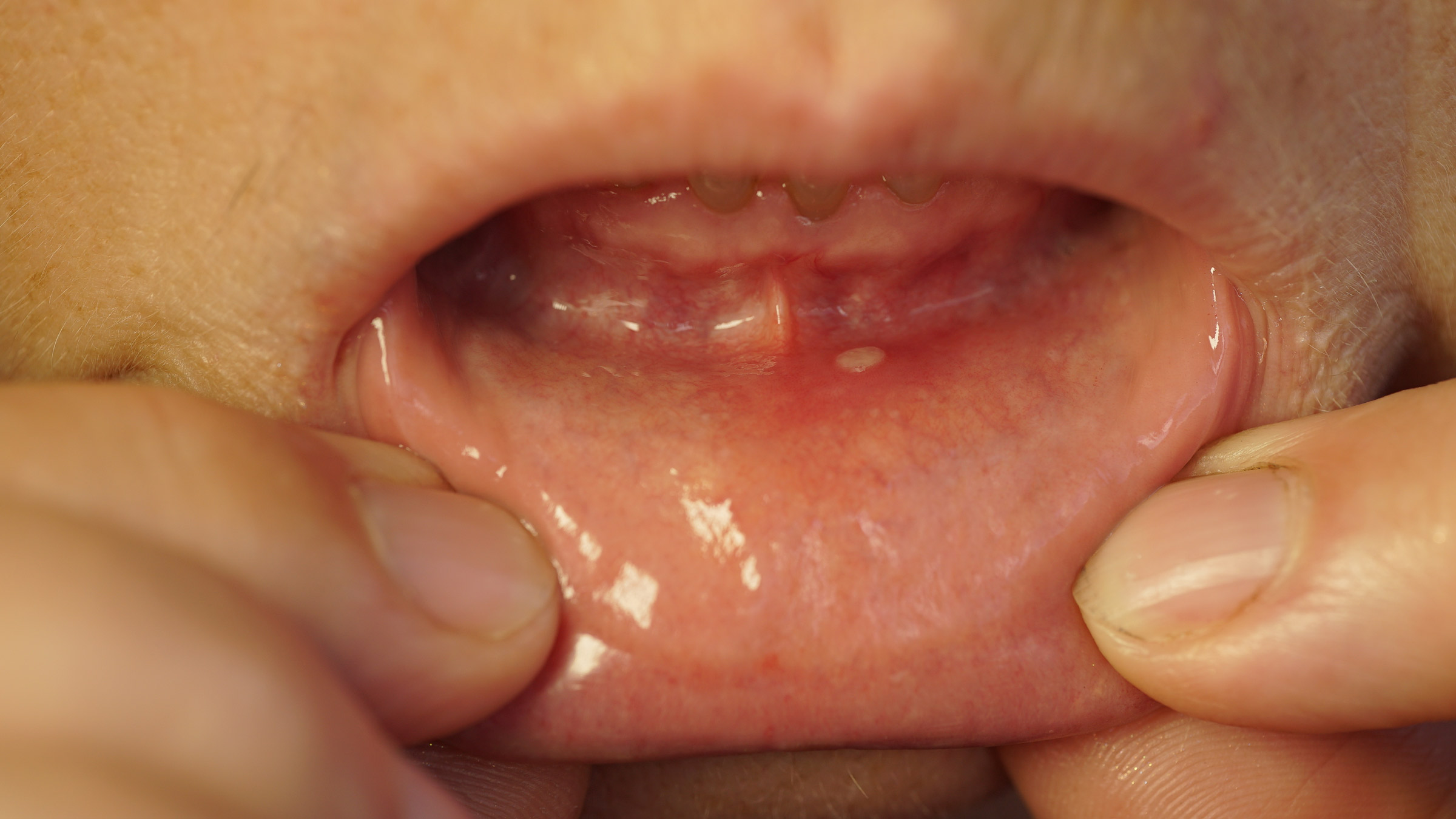 white spots inside lips