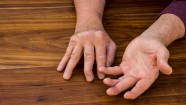 Do You Get Disability Benefits For Psoriatic Arthritis GoodRx