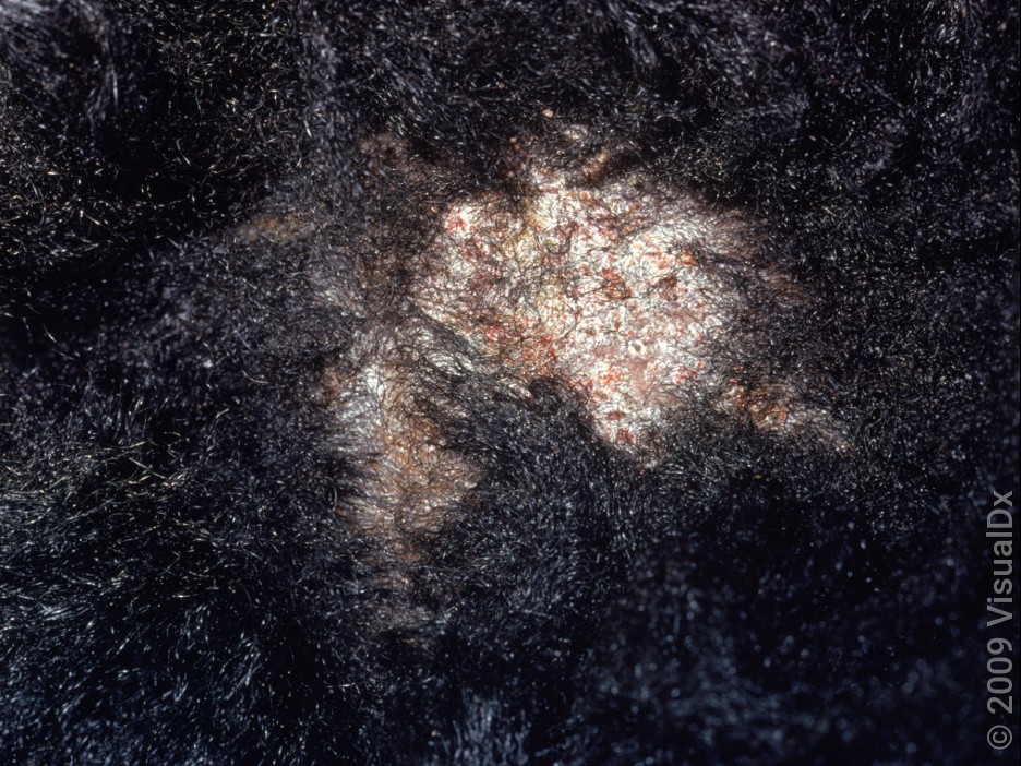 Close-up of scalp ringworm (tinea capitis) with hair loss. 