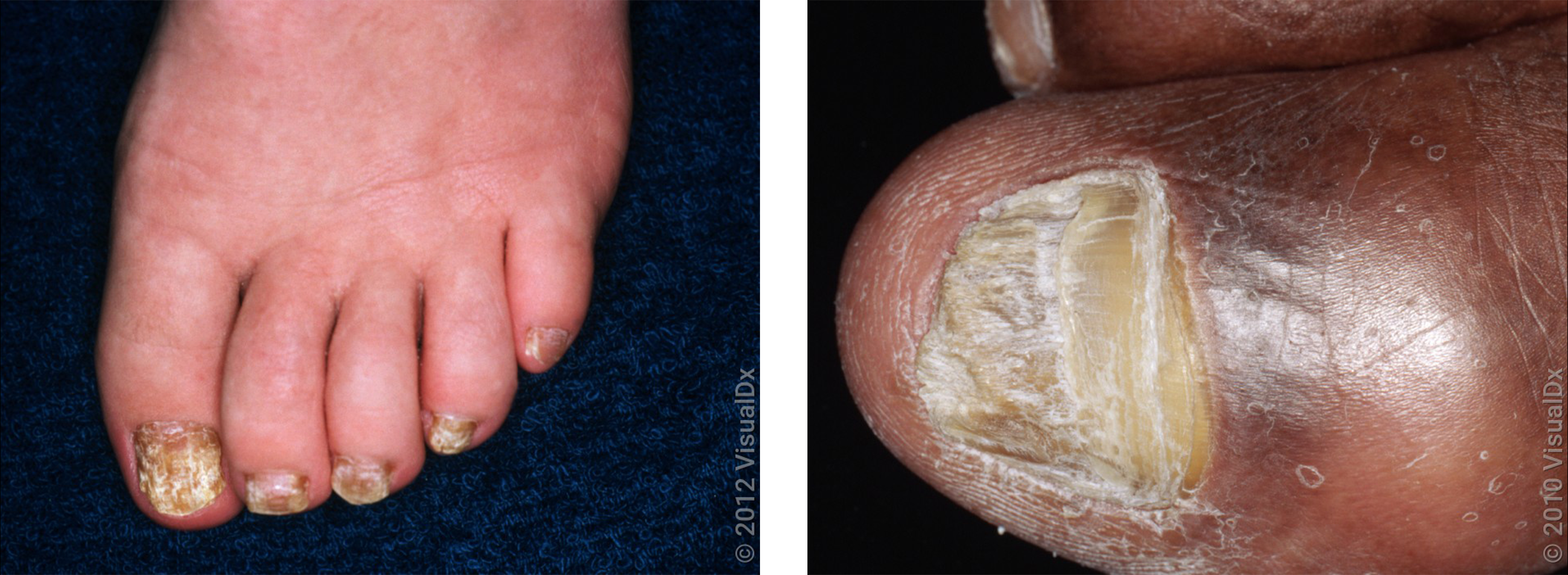 Nail Psoriasis - Richmond Dermatology