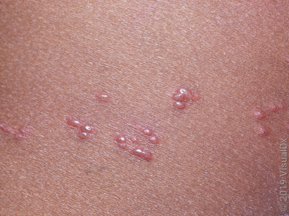 What to Expect With Shingles Rash: Early Stages and Progression - GoodRx