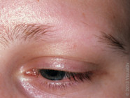 Living With Alopecia Areata Emotional Effects Coping And Images GoodRx