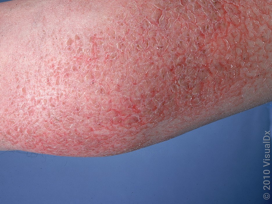 Asteatotic eczema on the leg. 