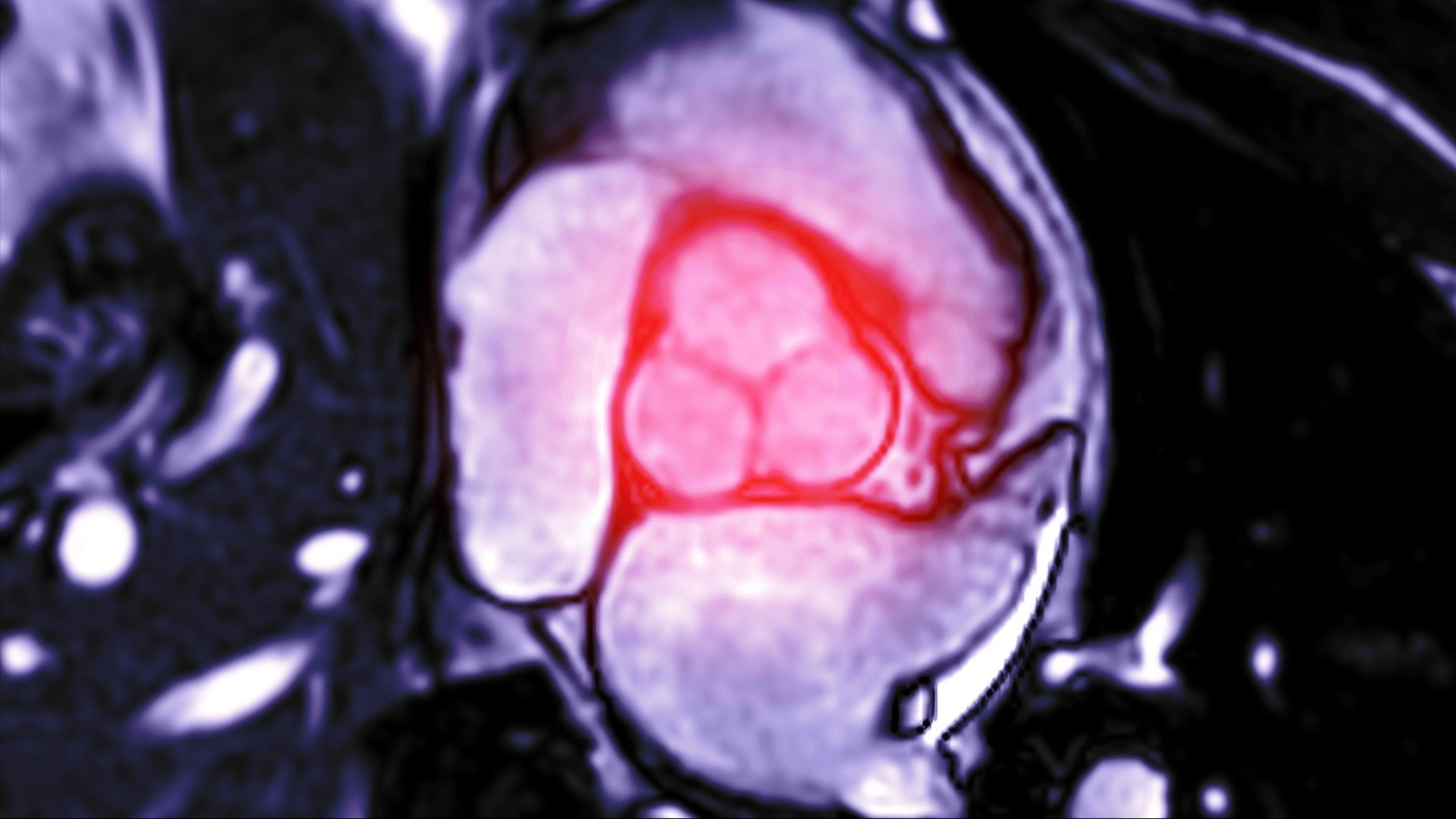 Aortic Valve Stenosis: Causes, Symptoms, and Treatment - GoodRx