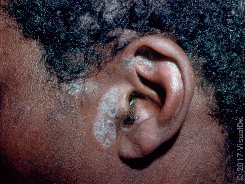 Psoriasis on the scalp and around the ear in darker skin.