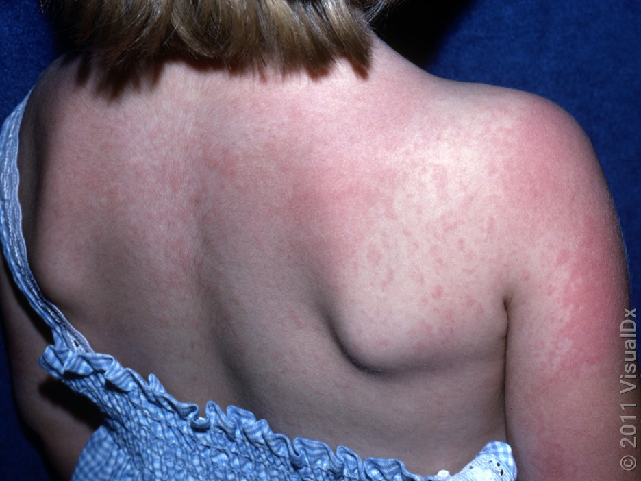 Close-up of a child’s back with a red scarlet fever rash. 