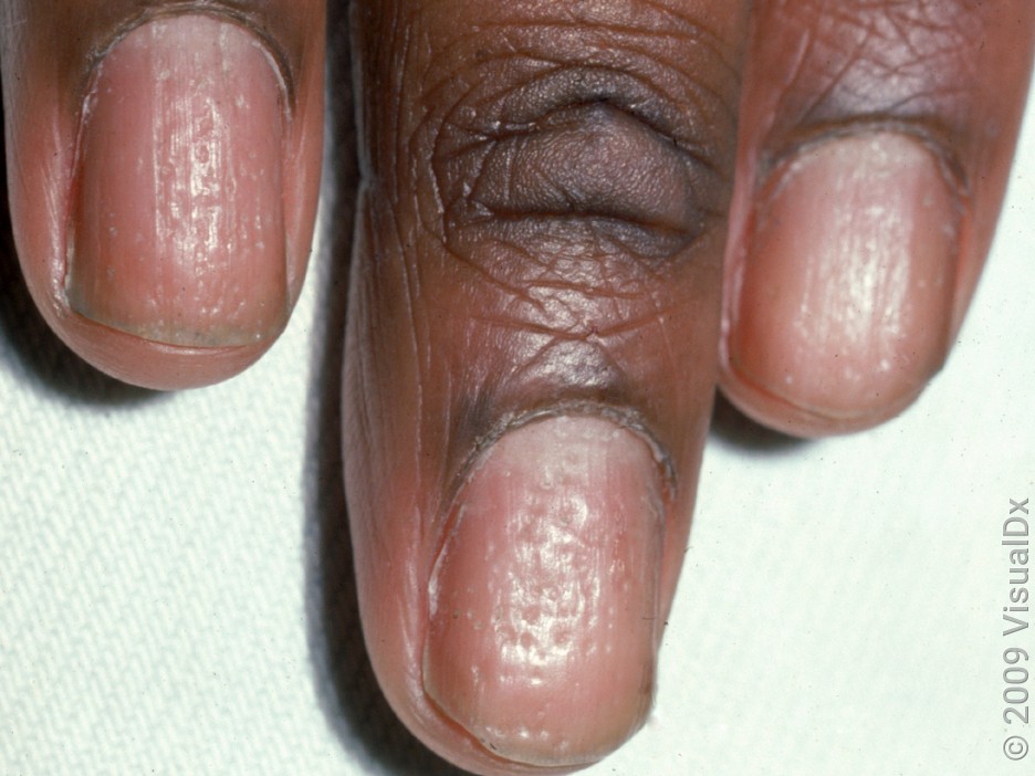 Close-up of nails with many tiny pits in nail psoriasis.