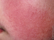 Keratosis Pilaris Chicken Skin Photos Causes Treatments GoodRx