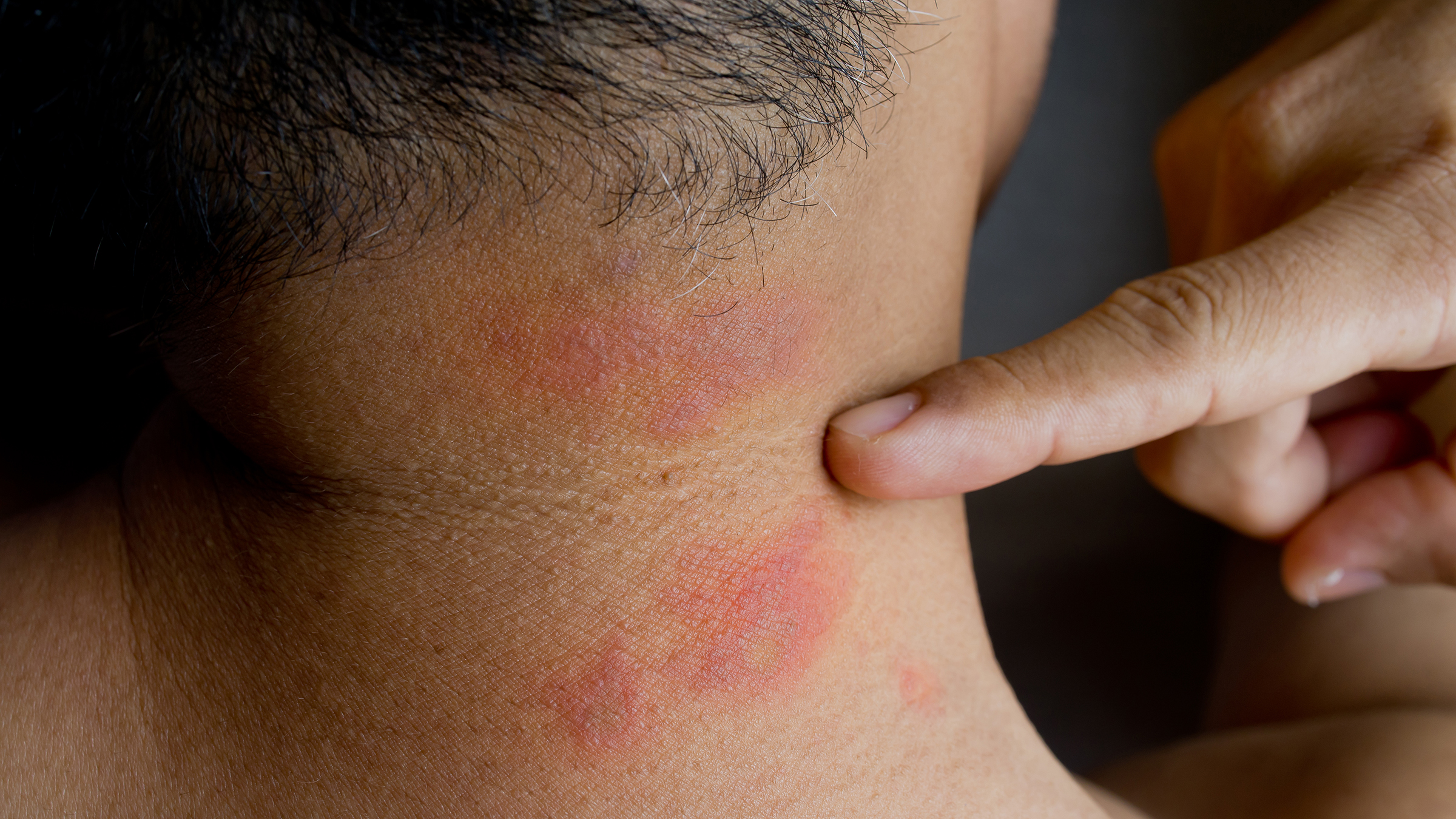 Mosquito Bites on the Skin Under the Breast Stock Photo - Image of