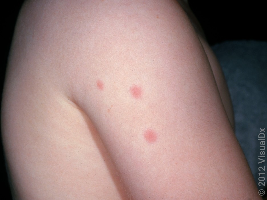 Small red bumps on lighter skin caused by bedbugs on the arm. 