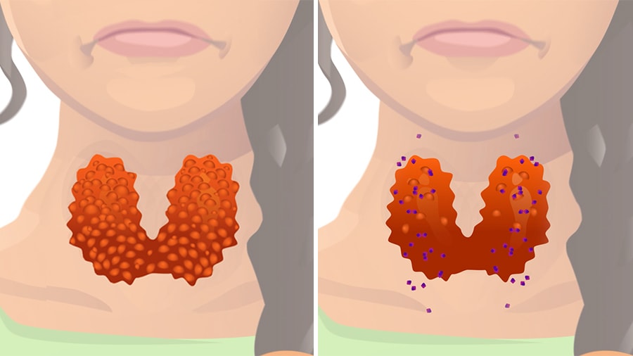 The Different Disorders That Cause Hyperthyroidism Goodrx