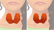 The Different Disorders That Cause Hyperthyroidism GoodRx