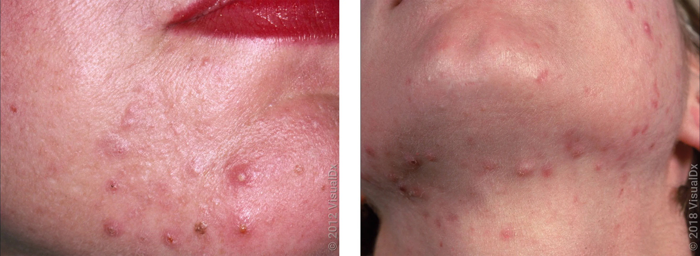 Left: Red bumps and pimples on the chin in hormonal acne. Right: Many red bumps and pimples on the cheek, chin, and neck.