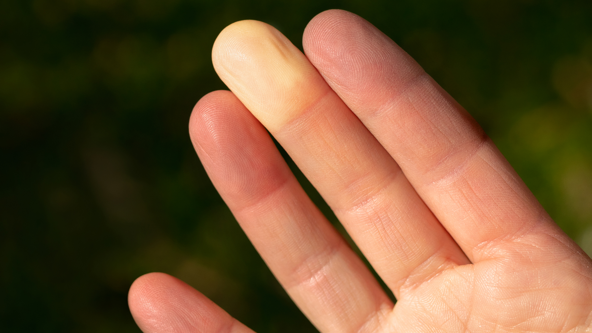 What Is Raynaud'S Phenomenon, And Why Does It Happen? - Goodrx