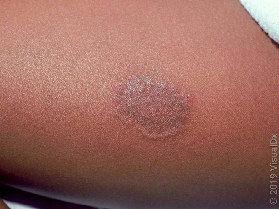 A round, brown patch with a red border on the skin in ringworm.