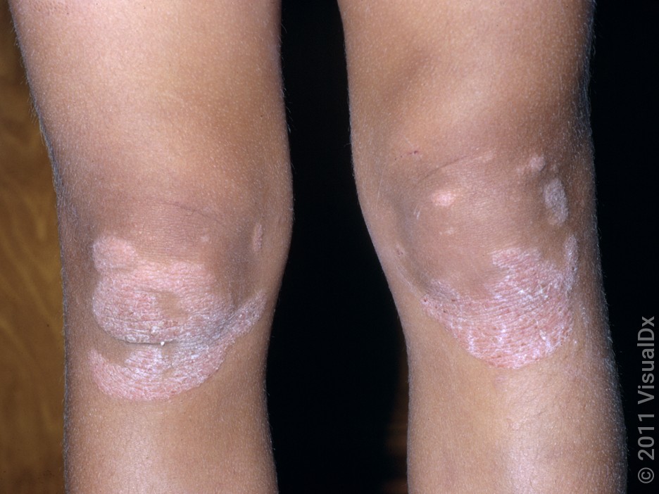 Psoriasis on the knees. 
