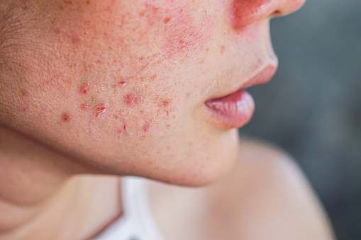Health: Acne: GettyImages-1270415883