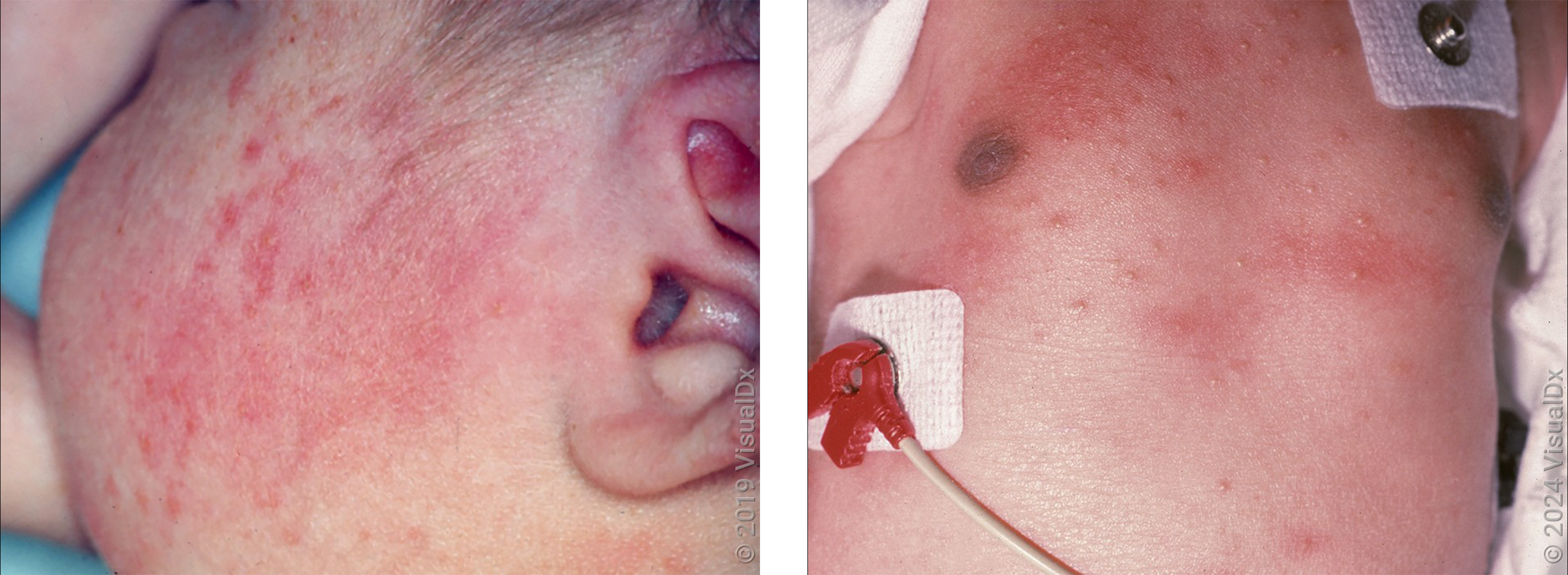 Left: Small, red bumps and patches on the cheek in an infant with erythema toxicum. Right: Many red bumps surrounded by redness on an infant’s chest with erythema toxicum.
